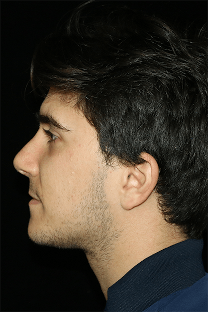 Primary Rhinoplasty Before & After Gallery - Patient 399055 - Image 4