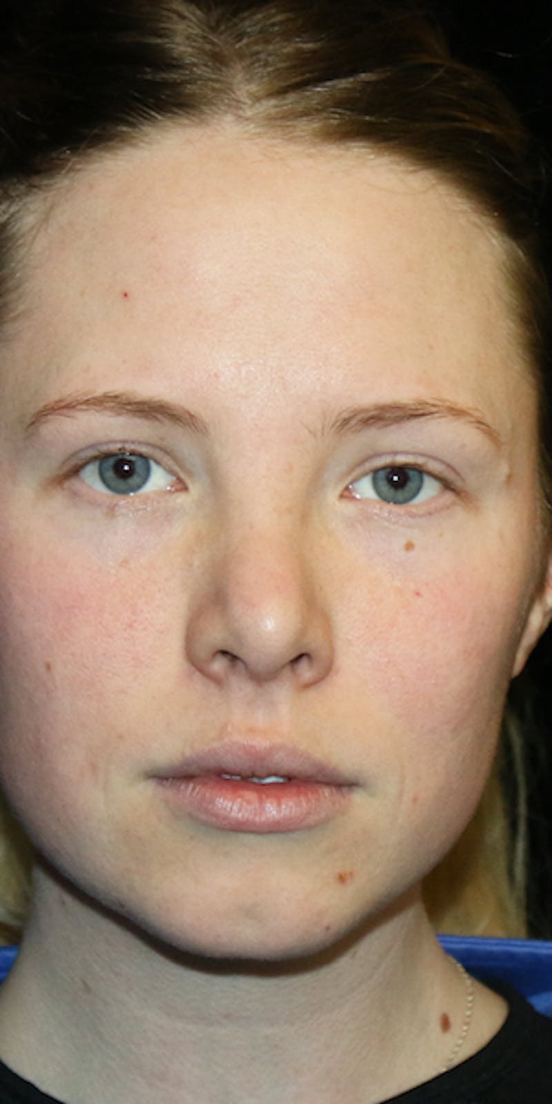 Secondary Rhinoplasty Before & After Gallery - Patient 418195 - Image 1