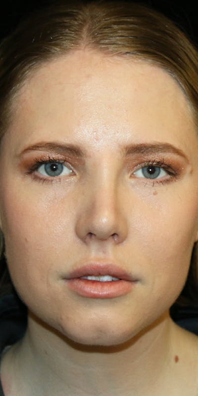 Secondary Rhinoplasty Before & After Gallery - Patient 418195 - Image 2