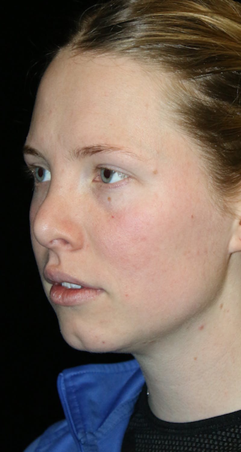 Secondary Rhinoplasty Before & After Gallery - Patient 418195 - Image 3