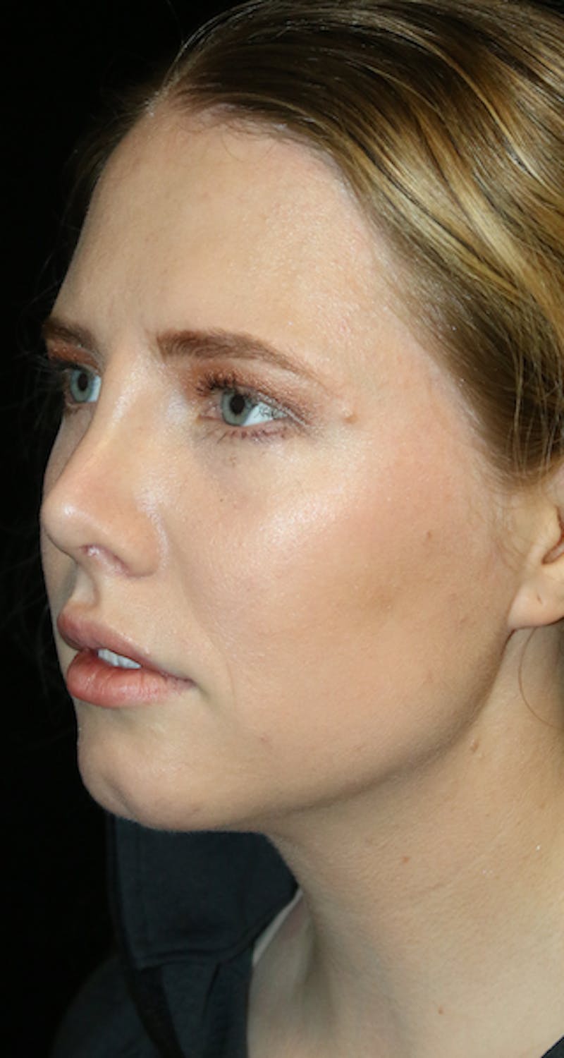 Secondary Rhinoplasty Before & After Gallery - Patient 418195 - Image 4