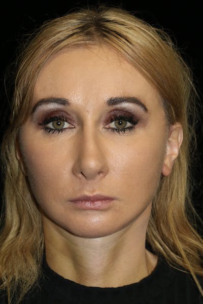 Secondary Rhinoplasty Before & After Gallery - Patient 167577 - Image 1