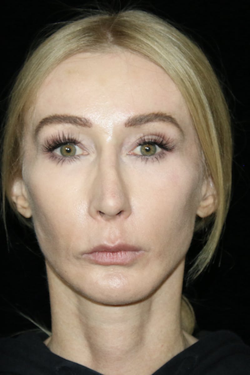 Secondary Rhinoplasty Before & After Gallery - Patient 167577 - Image 2