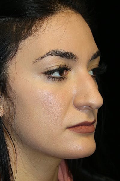 Secondary Rhinoplasty Before & After Gallery - Patient 286310 - Image 1