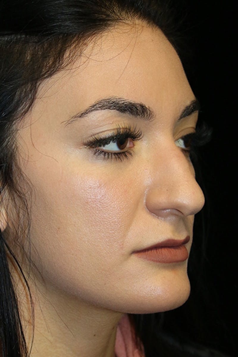 Secondary Rhinoplasty Before & After Gallery - Patient 286310 - Image 1