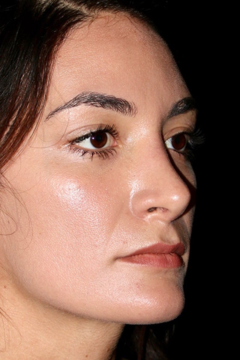 Secondary Rhinoplasty Before & After Gallery - Patient 286310 - Image 2