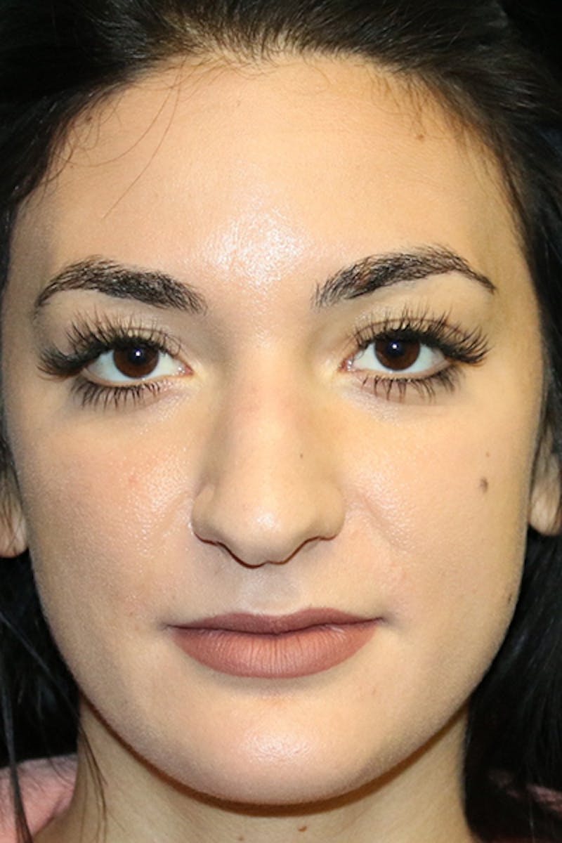 Secondary Rhinoplasty Before & After Gallery - Patient 286310 - Image 3