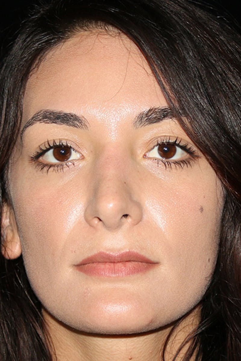 Secondary Rhinoplasty Before & After Gallery - Patient 286310 - Image 4