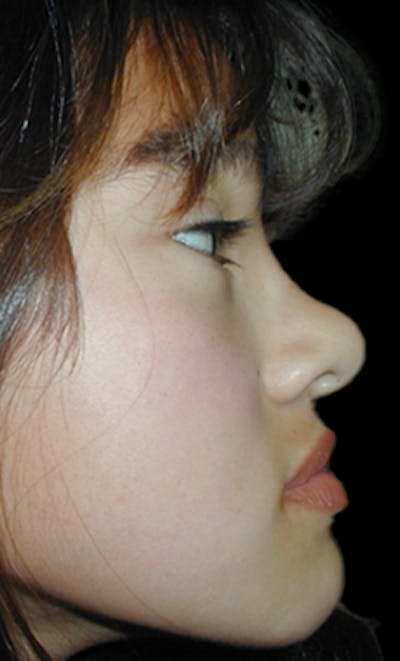 Reconstructive Rhinoplasty Before & After Gallery - Patient 861225 - Image 1
