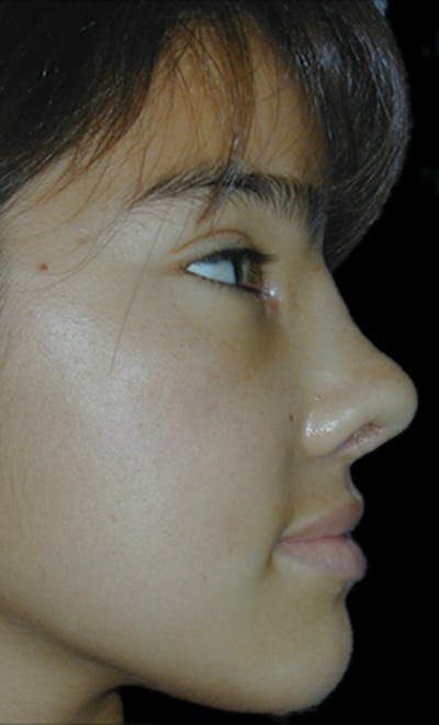 Reconstructive Rhinoplasty Before & After Gallery - Patient 861225 - Image 2