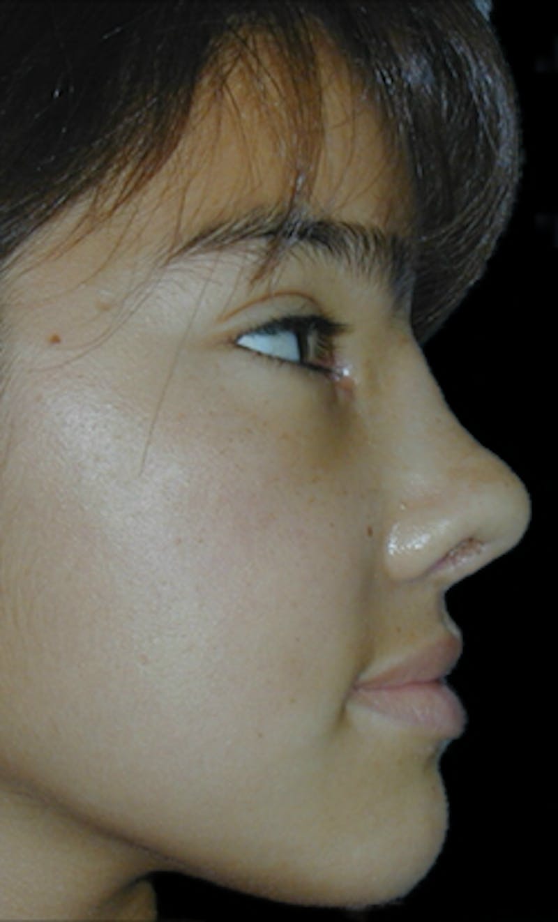 Reconstructive Rhinoplasty Before & After Gallery - Patient 861225 - Image 2