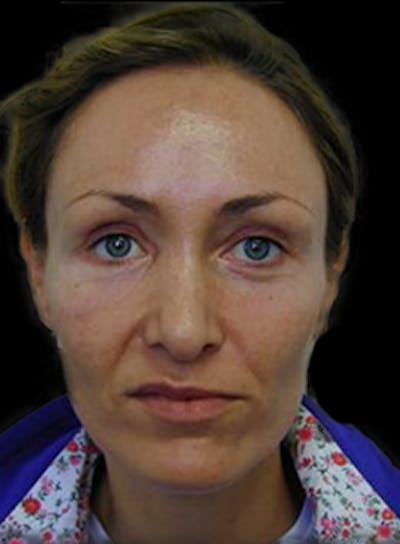 Reconstructive Rhinoplasty Before & After Gallery - Patient 450485 - Image 1