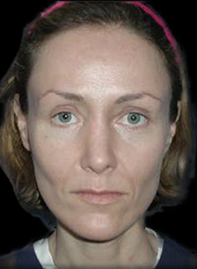 Reconstructive Rhinoplasty Before & After Gallery - Patient 450485 - Image 2