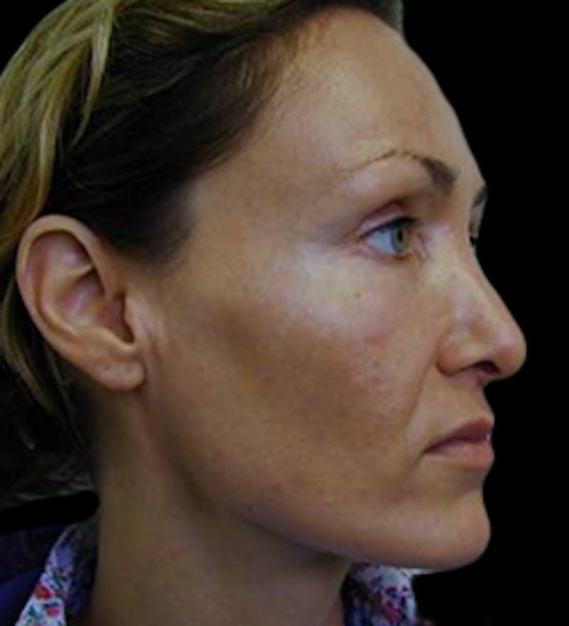 Reconstructive Rhinoplasty Before & After Gallery - Patient 450485 - Image 3
