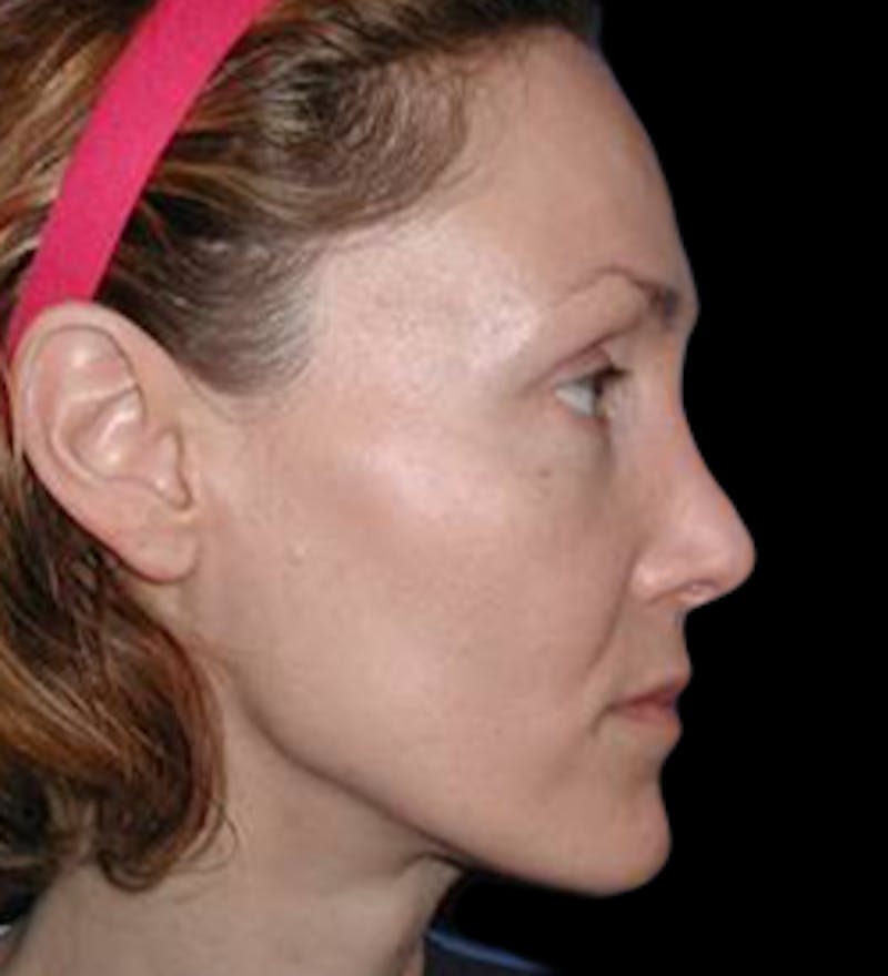 Reconstructive Rhinoplasty Before & After Gallery - Patient 450485 - Image 4