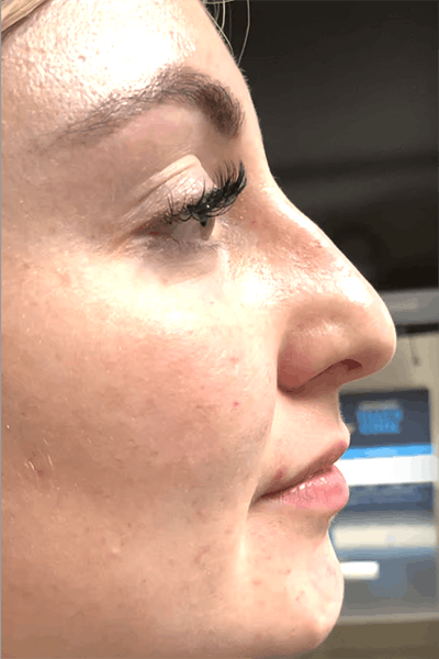 Non-Surgical Rhinoplasty Before & After Gallery - Patient 399627 - Image 1
