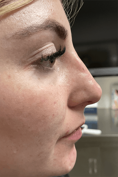 Non-Surgical Rhinoplasty Before & After Gallery - Patient 399627 - Image 2