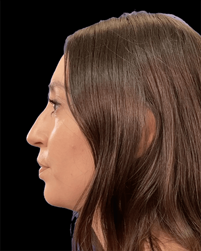 Non-Surgical Rhinoplasty Before & After Gallery - Patient 217754 - Image 1