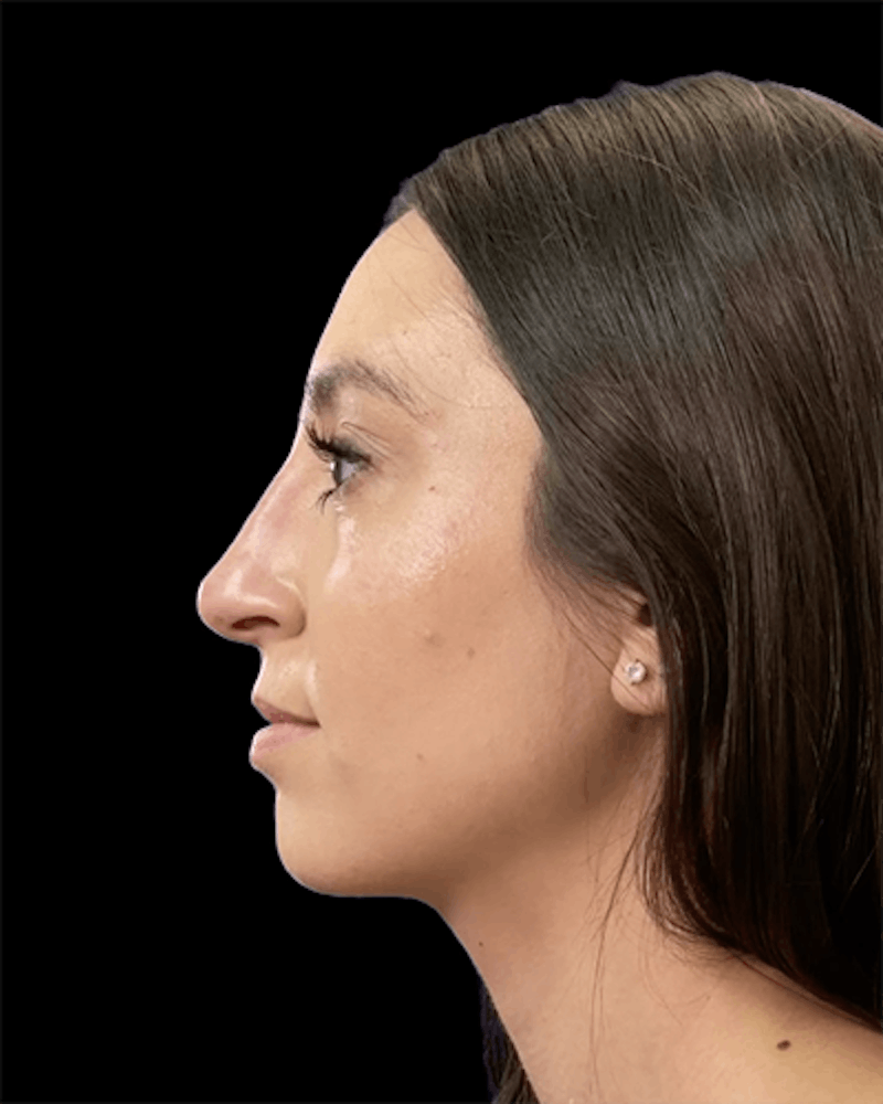 Non-Surgical Rhinoplasty Before & After Gallery - Patient 217754 - Image 2