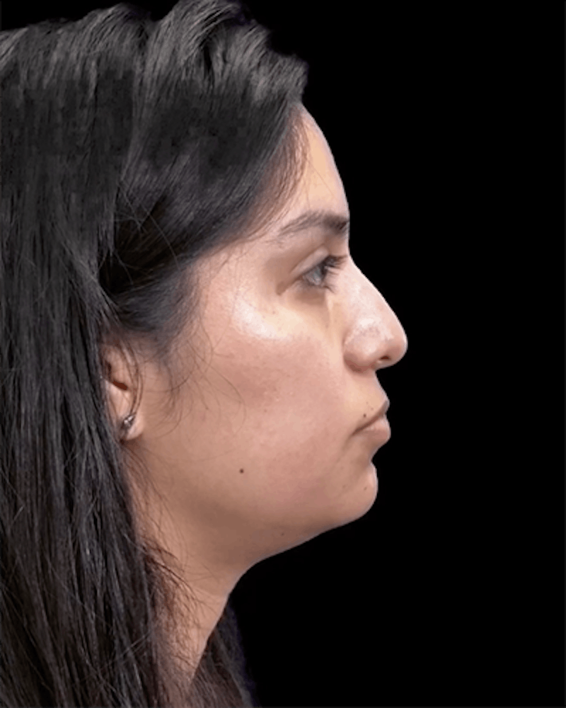 Non-Surgical Rhinoplasty Before & After Gallery - Patient 421424 - Image 1