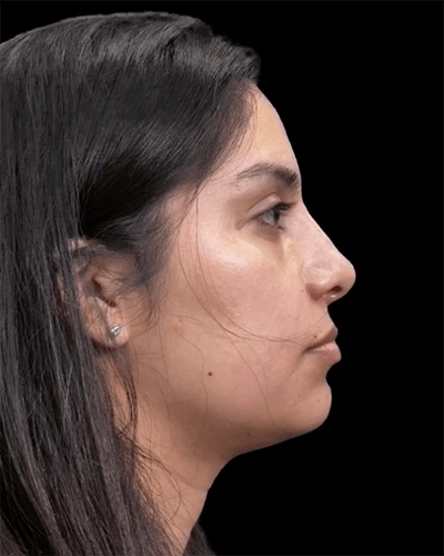 Non-Surgical Rhinoplasty Before & After Gallery - Patient 421424 - Image 2