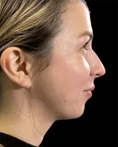 Non-Surgical Rhinoplasty Before & After Gallery - Patient 508716 - Image 1