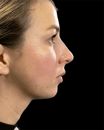 Non-Surgical Rhinoplasty Before & After Gallery - Patient 508716 - Image 2
