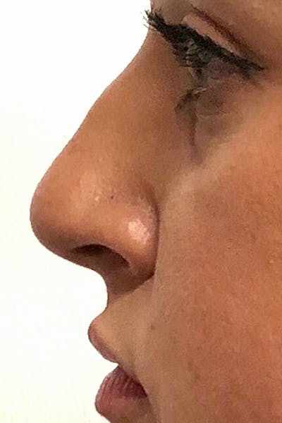 Non-Surgical Rhinoplasty Before & After Gallery - Patient 113962 - Image 1