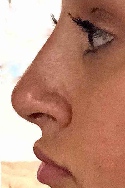 Non-Surgical Rhinoplasty Before & After Gallery - Patient 113962 - Image 2