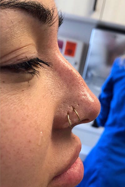 Non-Surgical Rhinoplasty Before & After Gallery - Patient 230535 - Image 1