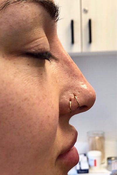 Non-Surgical Rhinoplasty Before & After Gallery - Patient 230535 - Image 2