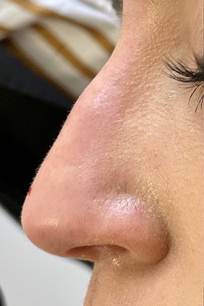 Non-Surgical Rhinoplasty Before & After Gallery - Patient 482256 - Image 1