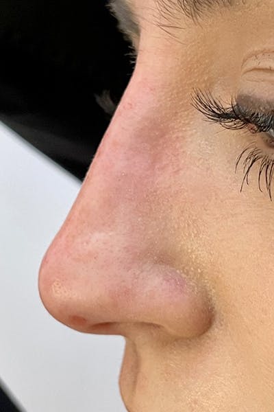 Non-Surgical Rhinoplasty Before & After Gallery - Patient 482256 - Image 2