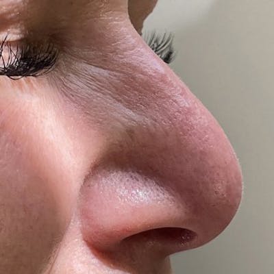 Non-Surgical Rhinoplasty Before & After Gallery - Patient 242157 - Image 1