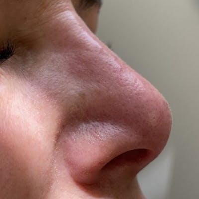Non-Surgical Rhinoplasty Before & After Gallery - Patient 242157 - Image 2