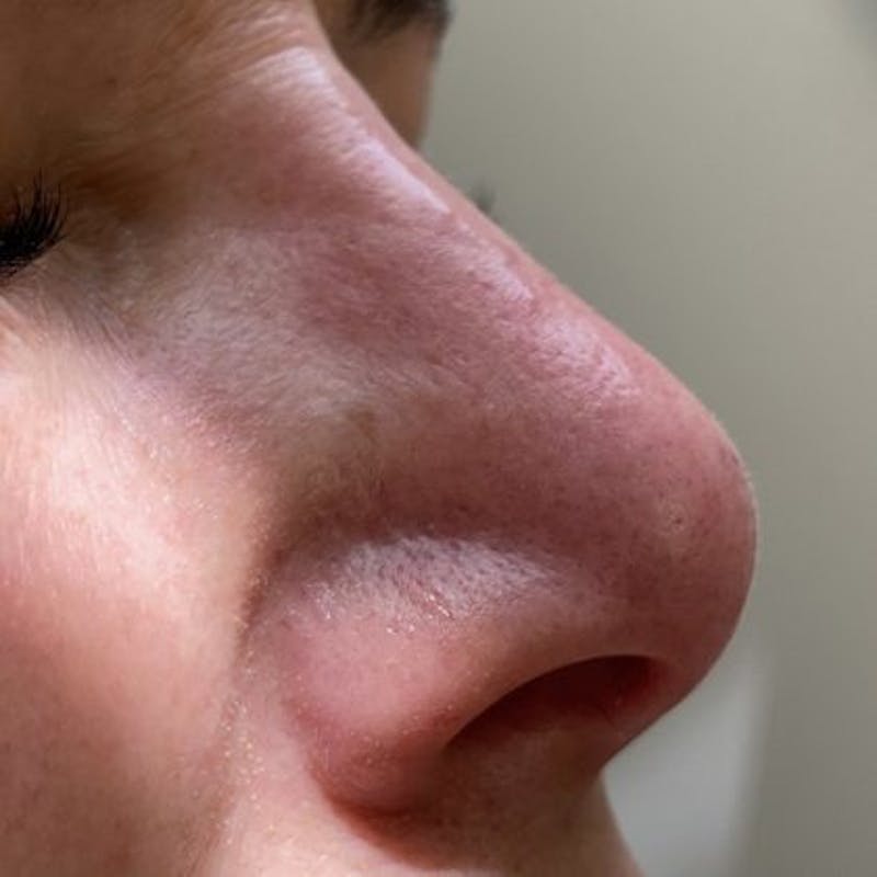 Non-Surgical Rhinoplasty Before & After Gallery - Patient 242157 - Image 2
