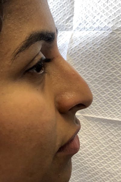 Non-Surgical Rhinoplasty Before & After Gallery - Patient 296533 - Image 1
