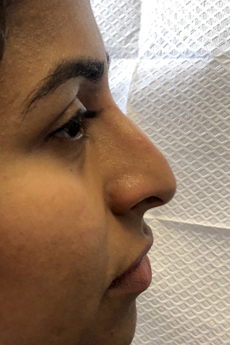 Non-Surgical Rhinoplasty Before & After Gallery - Patient 296533 - Image 1