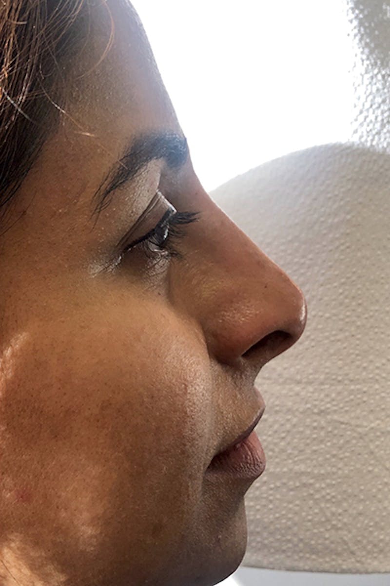 Non-Surgical Rhinoplasty Before & After Gallery - Patient 296533 - Image 2