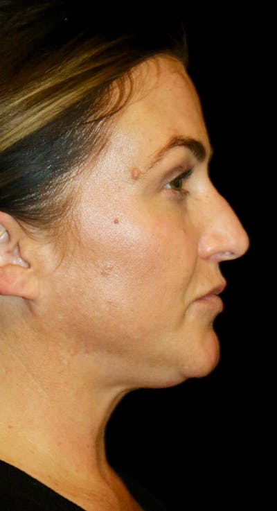 Non-Surgical Rhinoplasty Before & After Gallery - Patient 354764 - Image 1