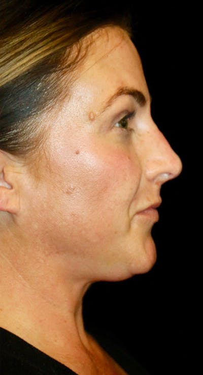 Non-Surgical Rhinoplasty Before & After Gallery - Patient 354764 - Image 2