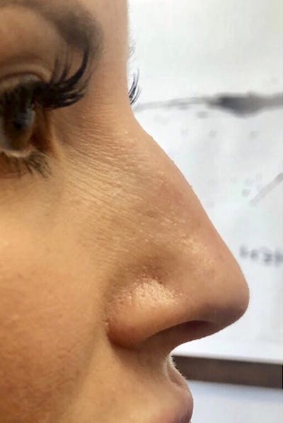 Non-Surgical Rhinoplasty Before & After Gallery - Patient 377669 - Image 1