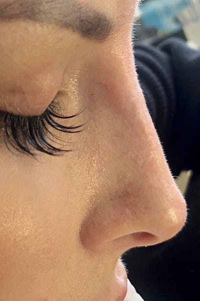Non-Surgical Rhinoplasty Before & After Gallery - Patient 377669 - Image 2