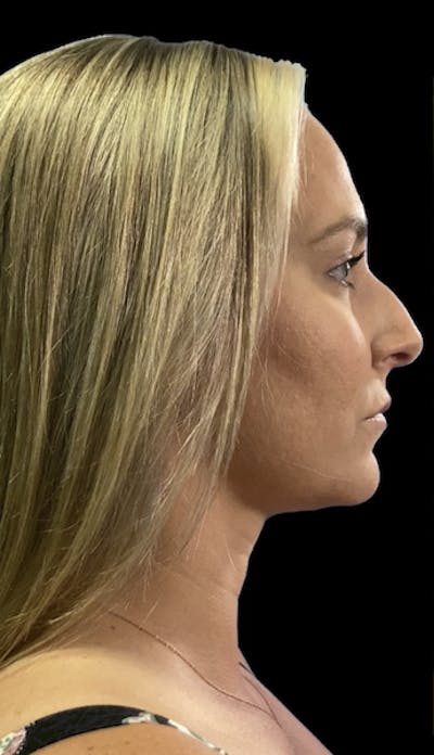 Non-Surgical Rhinoplasty Before & After Gallery - Patient 334083 - Image 1