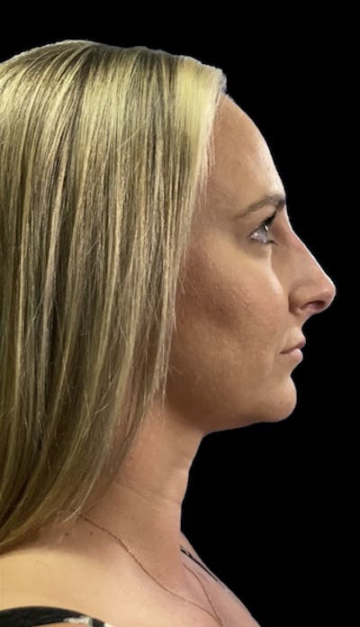 Non-Surgical Rhinoplasty Before & After Gallery - Patient 334083 - Image 2