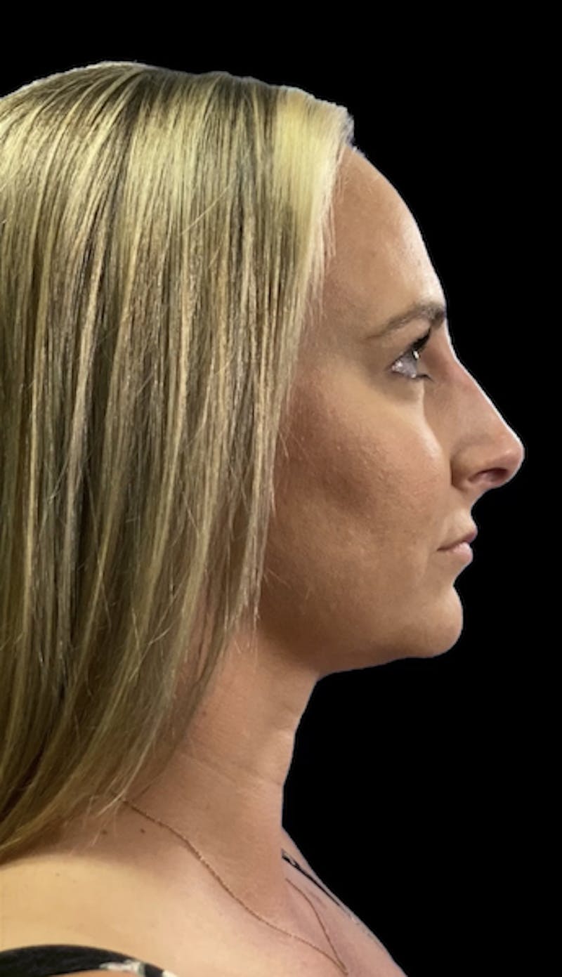 Non-Surgical Rhinoplasty Before & After Gallery - Patient 334083 - Image 2