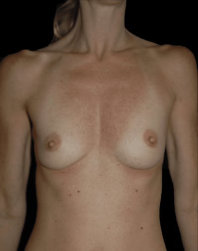 Breast Augmentation with Fat Grafting Before & After Gallery - Patient 609060 - Image 1