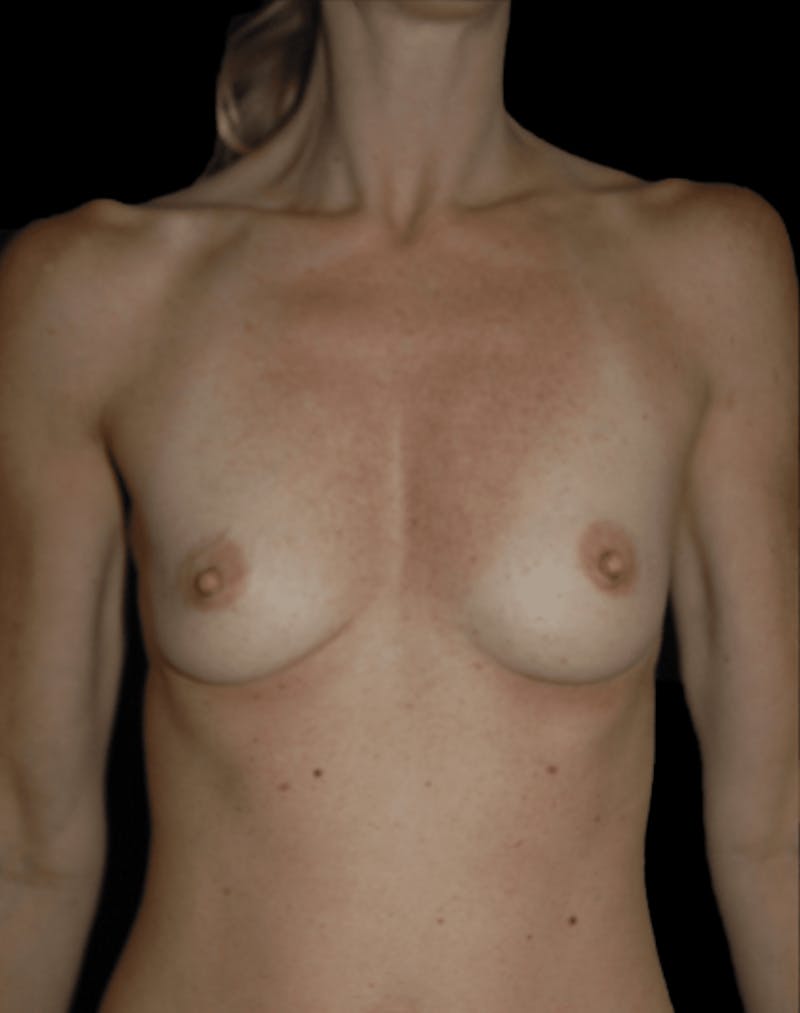 Breast Augmentation with Fat Grafting Before & After Gallery - Patient 609060 - Image 1