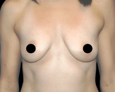 Breast Augmentation with Fat Grafting Before & After Gallery - Patient 309624 - Image 1