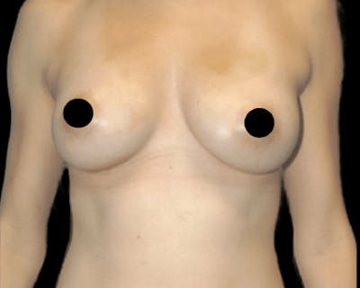 Breast Augmentation with Fat Grafting Before & After Gallery - Patient 309624 - Image 2
